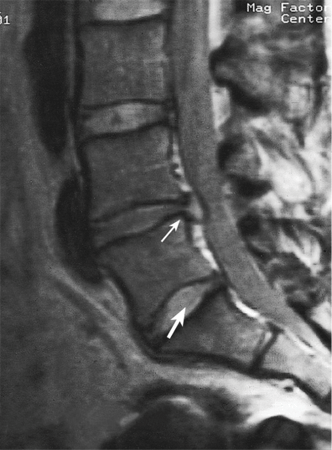 MRI of herniated disc