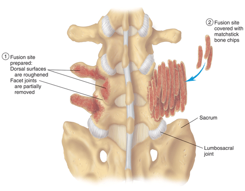 Vertebral fusion